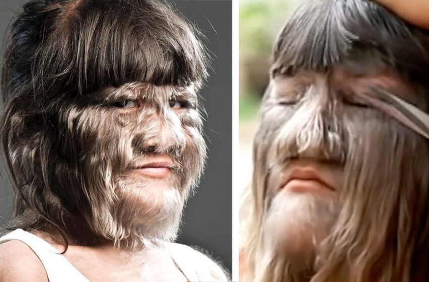  The Girl Was Bullied for Hairy Face: She Grew Up And Turned Into a Real Beauty!